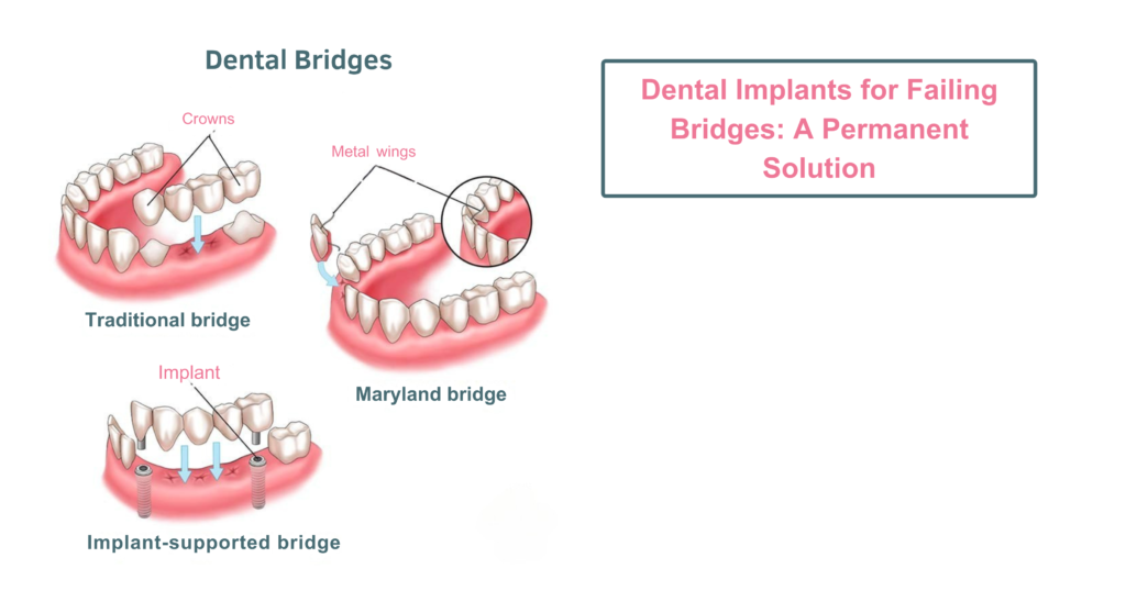 Dental Implants for Failing Bridges A Permanent Solution