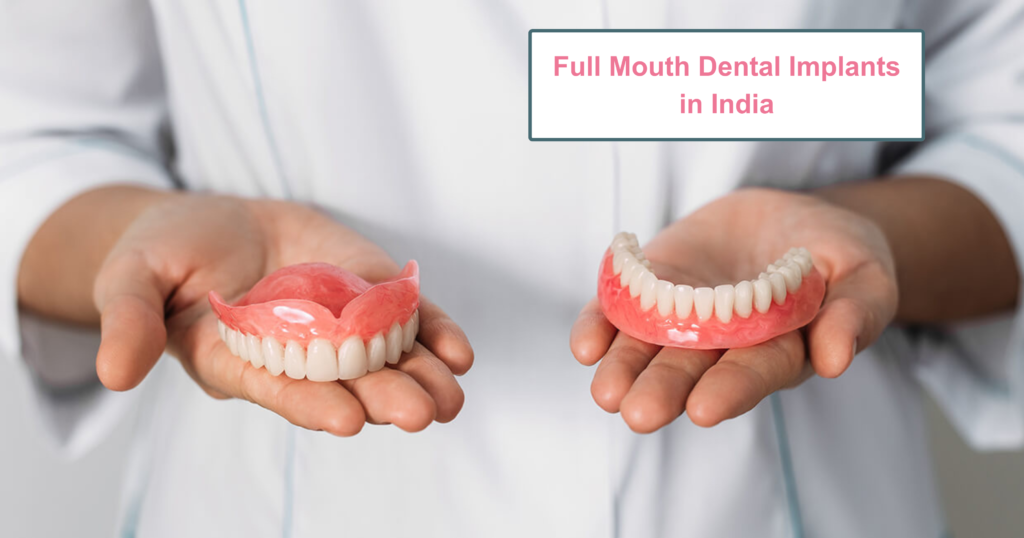 Full Mouth Dental Implants in India