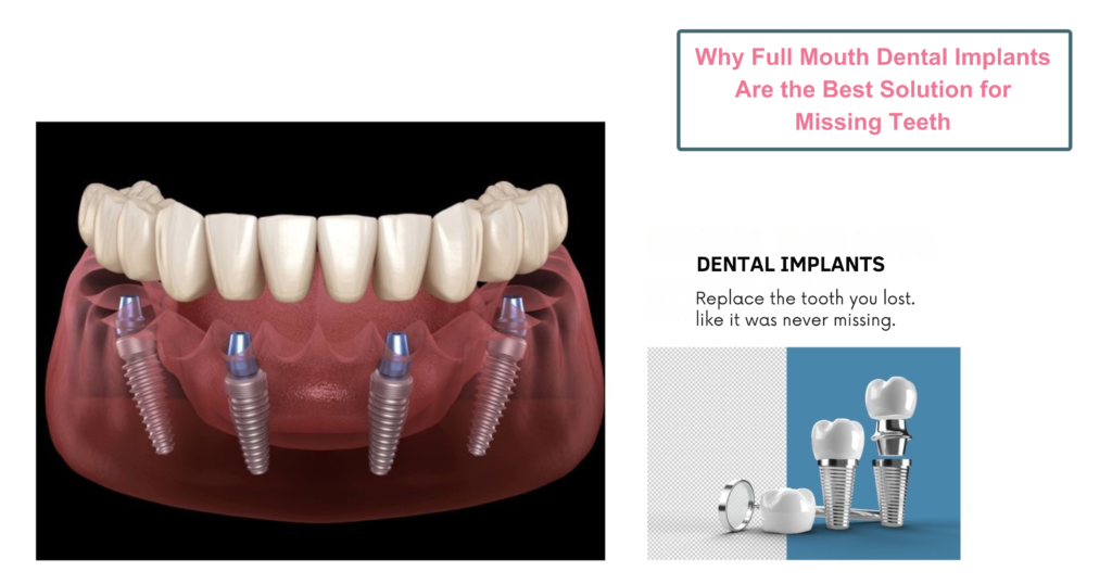 Why Full Mouth Dental Implants Are the Best Solution for Missing Teeth